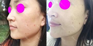 欧美点痣教程图解视频,图解视频精华概述